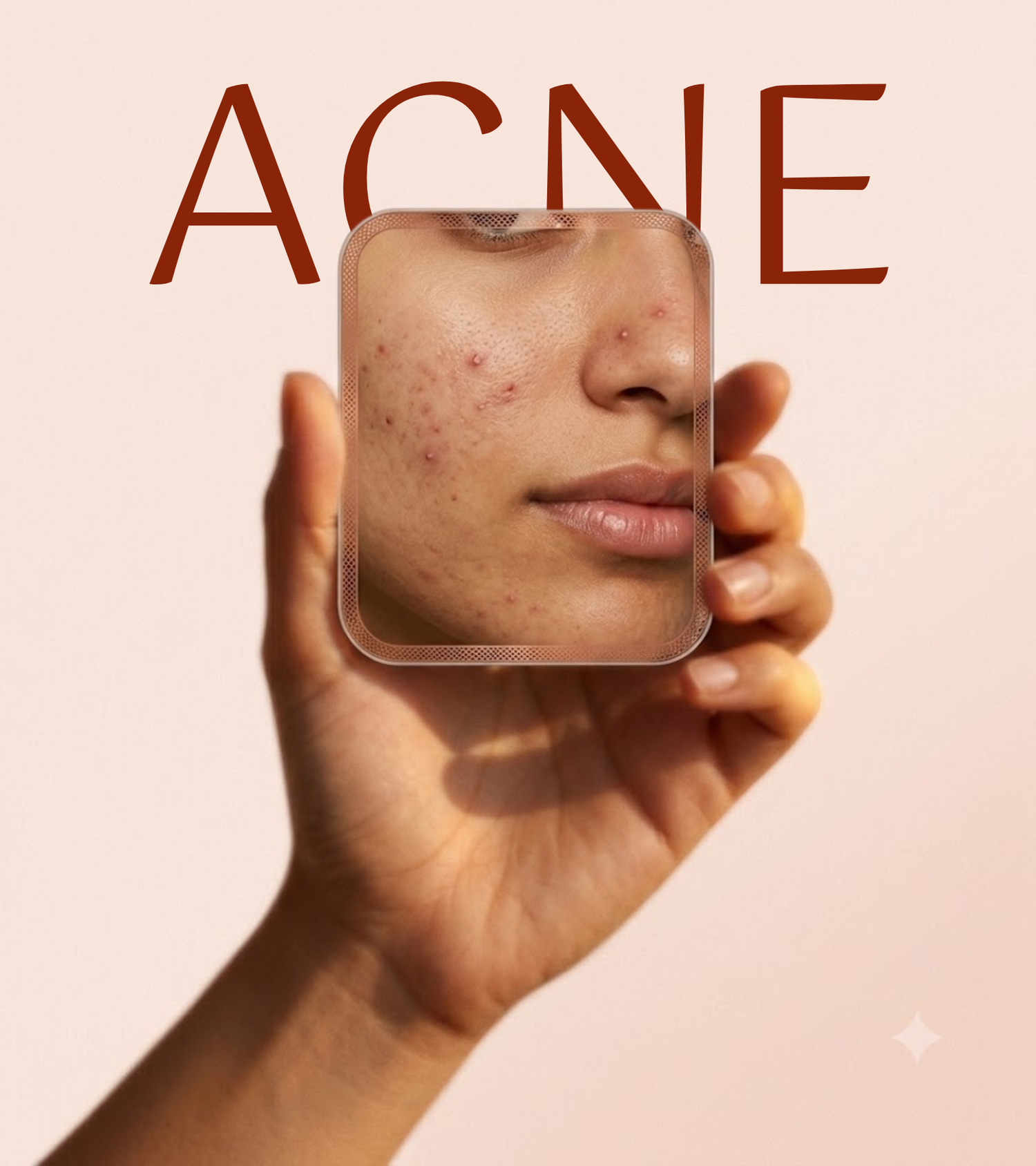 Acne