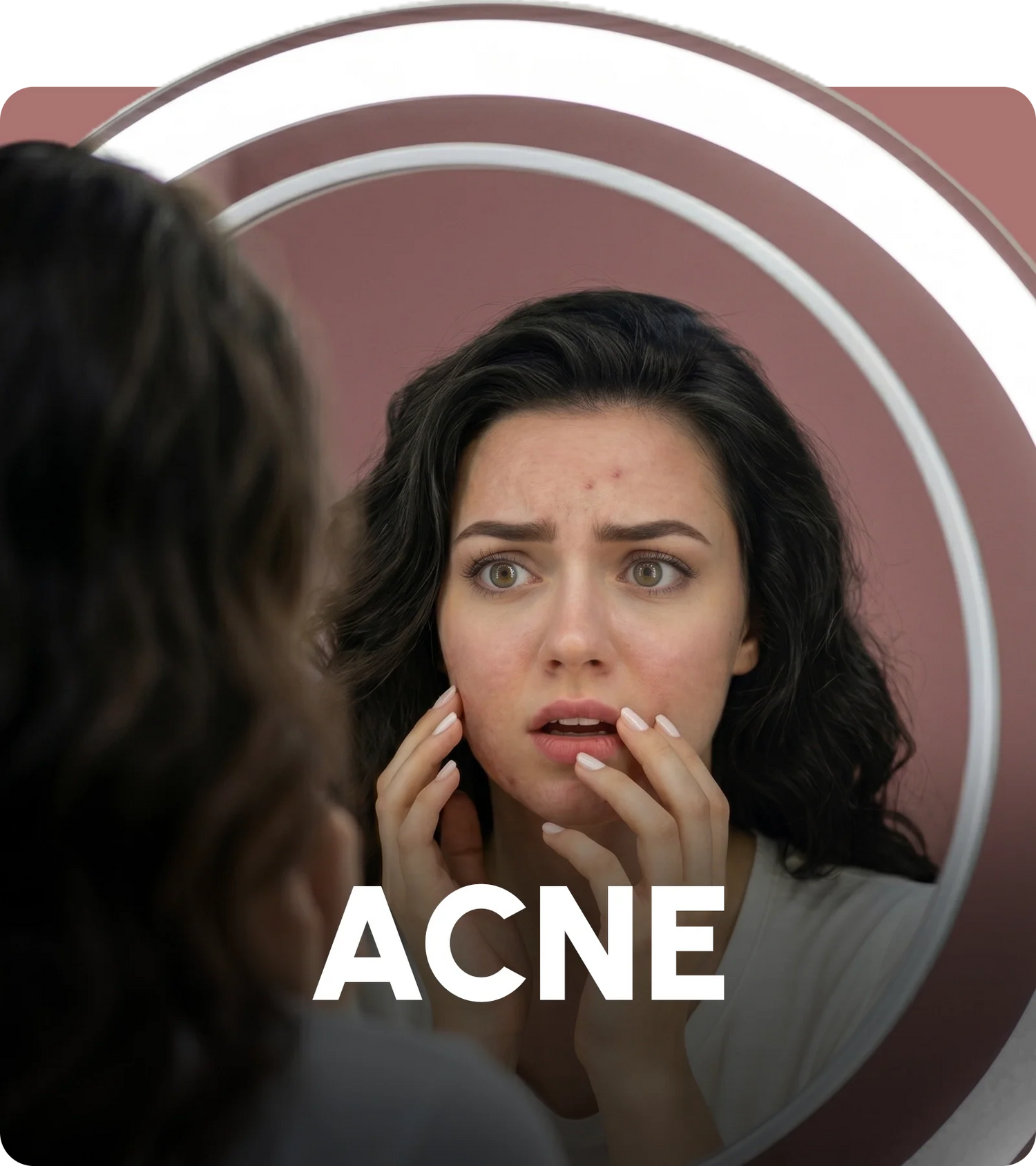 Acne