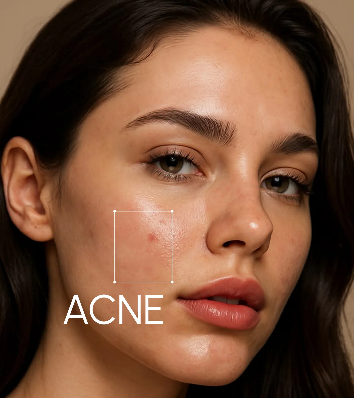 Acne